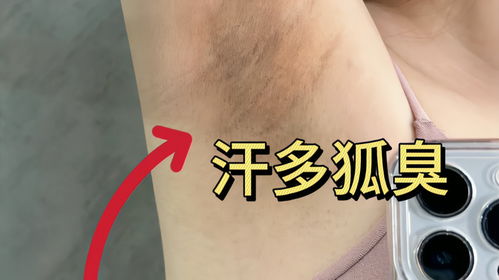 狐臭改善只需两招,腋下异味多汗全没了