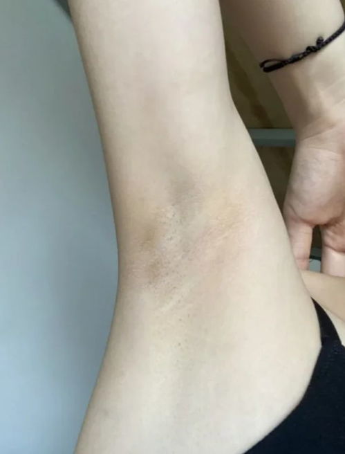 狐臭就这么没了 真的行