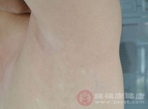 去腋臭小窍门
