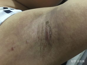 做狐臭手术需要多少钱啊